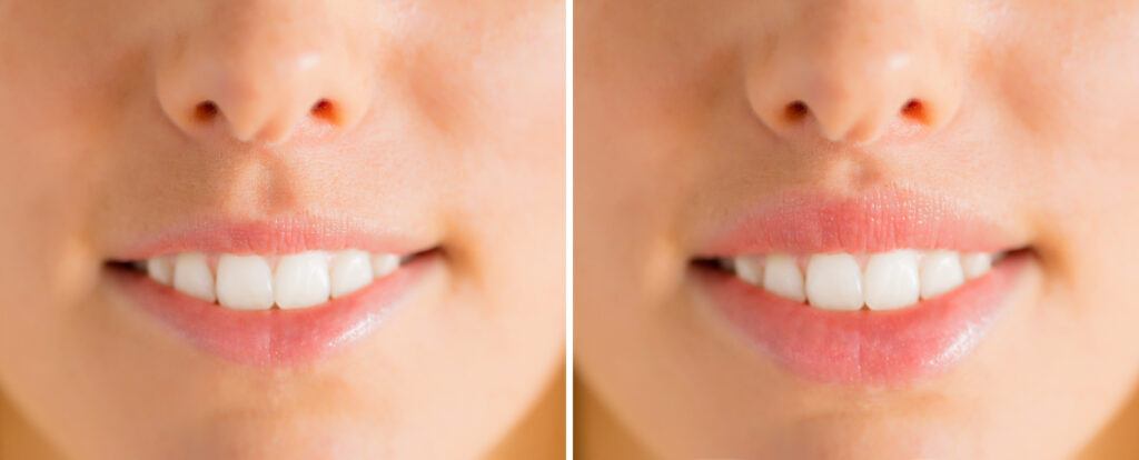 before and after photos of Juvederm Ultra Plus lip fillers and PDO Threads