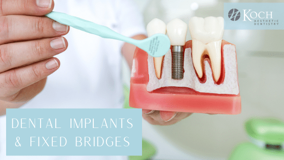 Dental Implants vs Fixed Bridges