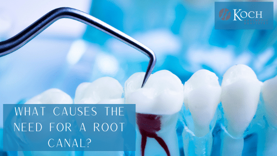 root canal