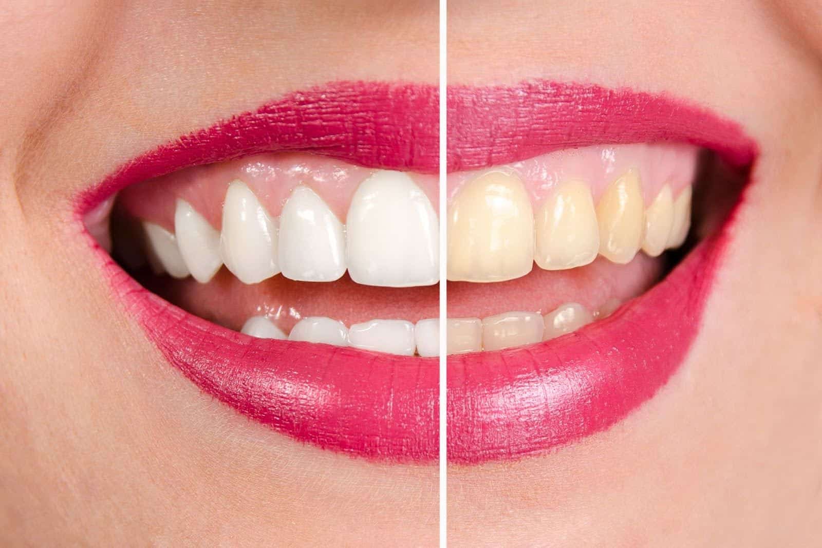 Before and after look at the teeth of a patient who had her teeth cleaned