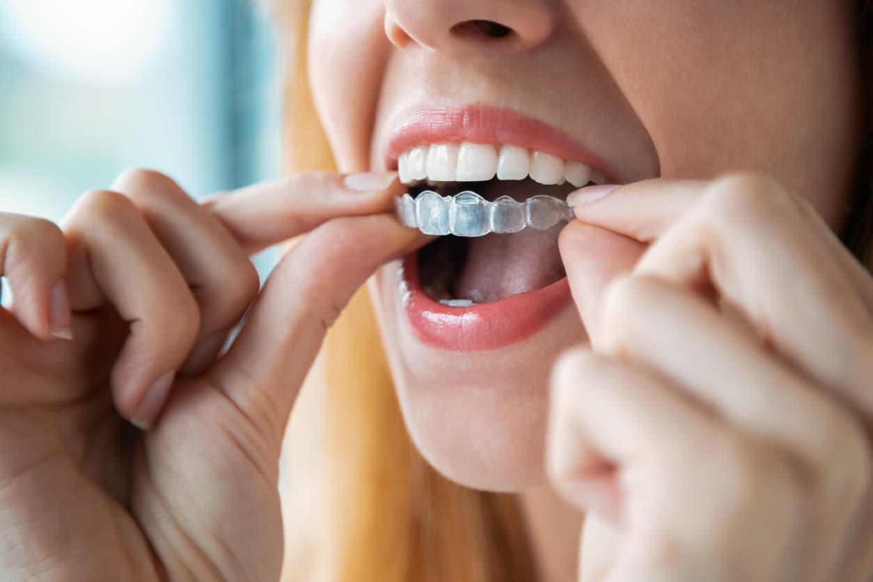 A woman puts an invisible aligner on her top teeth.