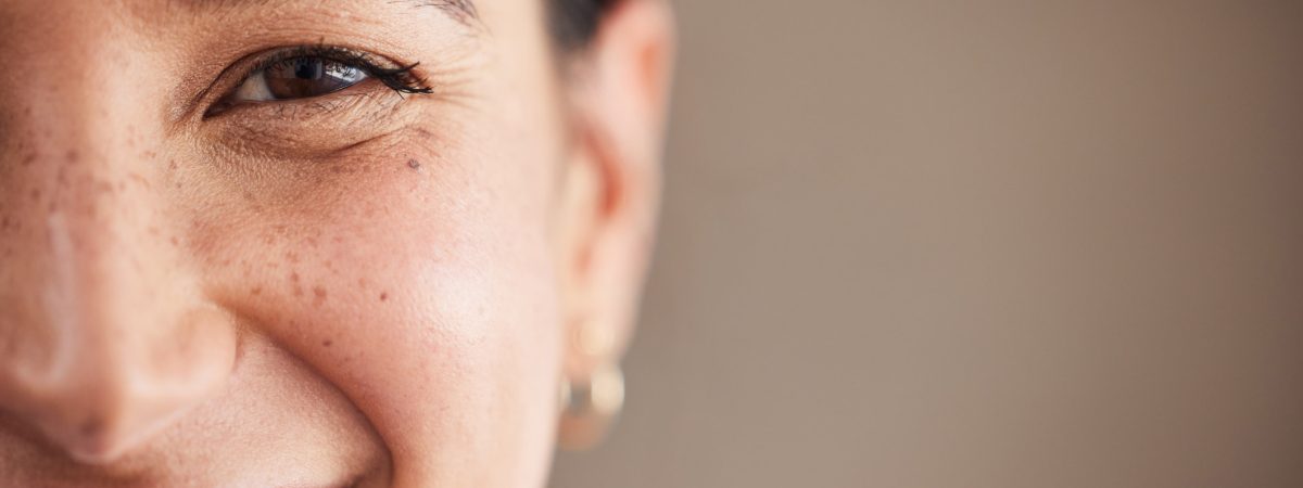 A woman with freckles smiles at the camera, showing off the results of her smile makeover.