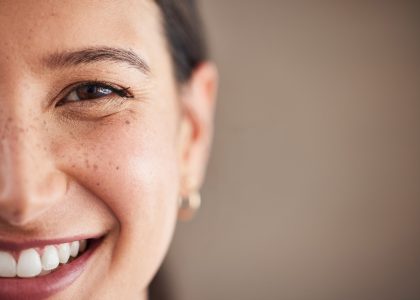 A woman with freckles smiles at the camera, showing off the results of her smile makeover.