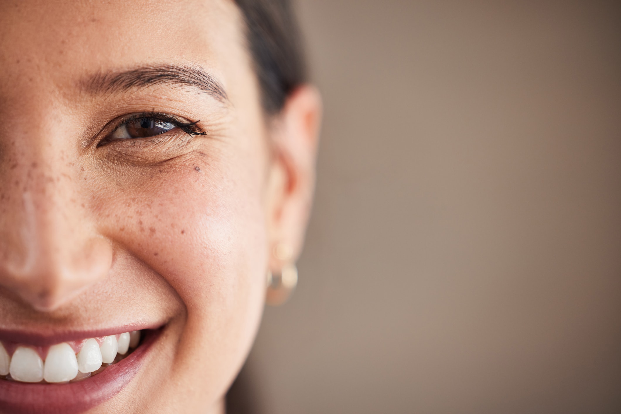 A woman with freckles smiles at the camera, showing off the results of her smile makeover.