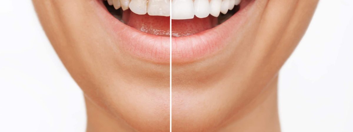 Before and after images of a woman with stunning white teeth, showcasing the results of her veneers.