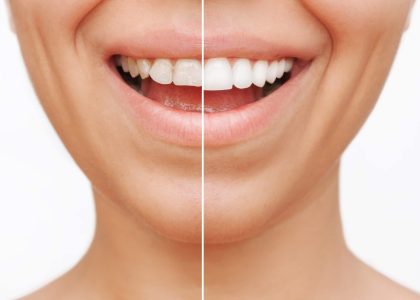 Before and after images of a woman with stunning white teeth, showcasing the results of her veneers.