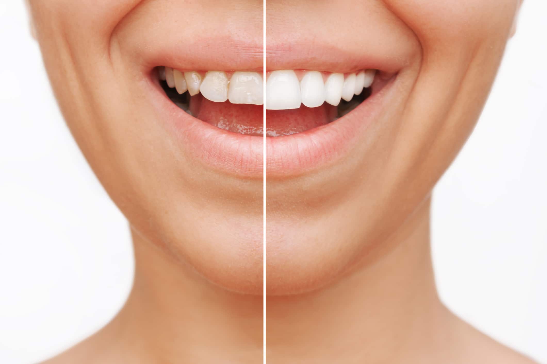 Before and after images of a woman with stunning white teeth, showcasing the results of her veneers.