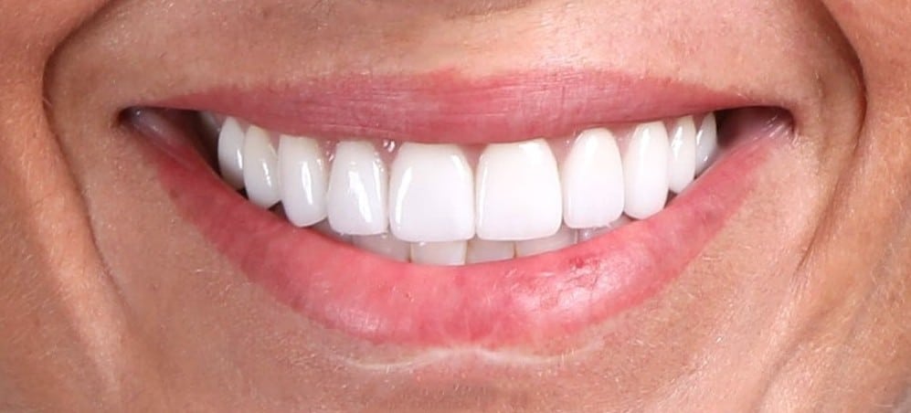 Real patient photo of a Koch Aesthetic Dentistry patient with veneers