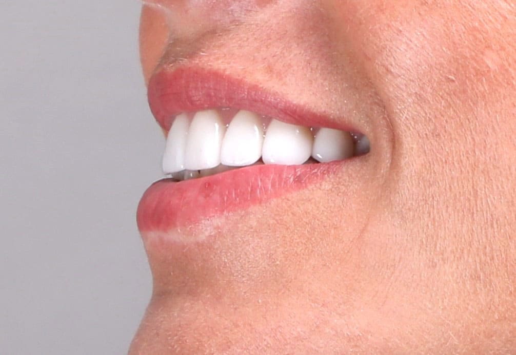 Real patient photo of a Koch Aesthetic Dentistry patient with veneers